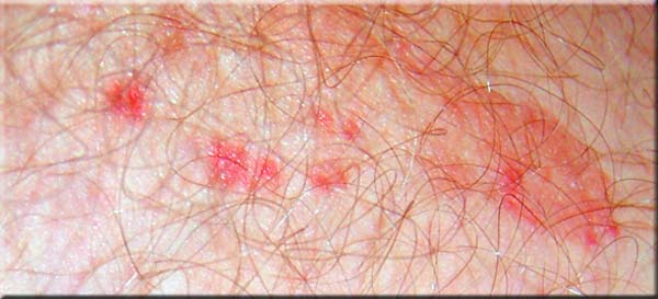 FirstSkin befreit zeitnah vom Juckreiz!