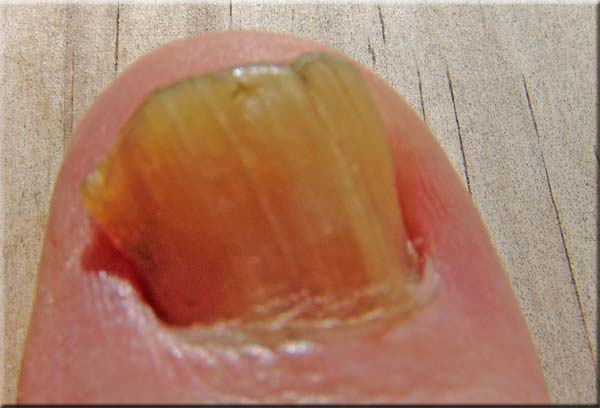 Bei Anwendung mit FirstSkin zeitnahe Erfolge!